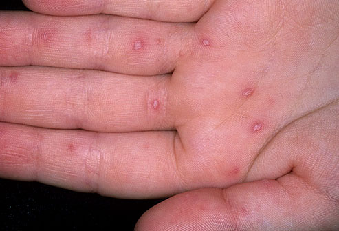 dermnet rf photo of hand foot mouth disease